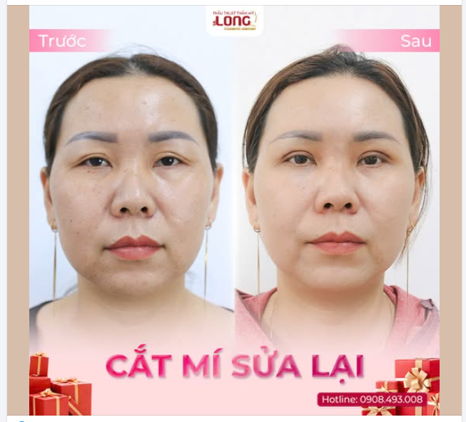 CẮT MÍ MẮT – BÍ QUYẾT LÀM ĐẸP TRƯỚC THỀM NĂM MỚI