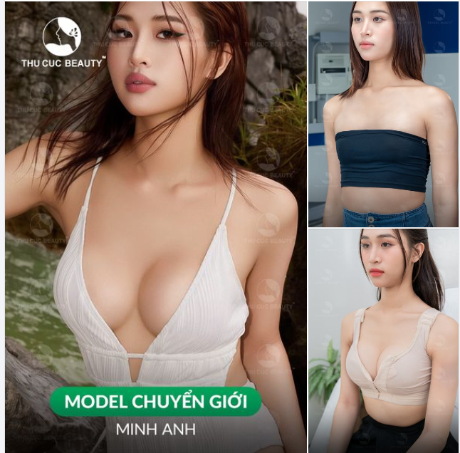 Không còn lo ngại V1 teo lép, bị mọi người body shaming Chọn Ngực TC 39.9Tr