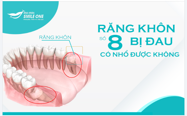 RĂNG KHÔN BỊ ĐAU CÓ NÊN NHỔ KHÔNG?