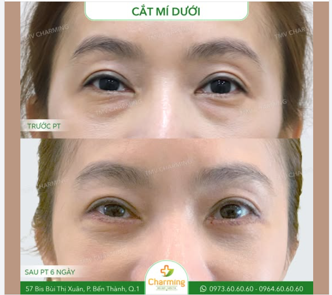 Nàng khách hàng này đã có một sự thay đổi tuyệt vời sau khi thực hiện cắt mí dưới tại TMV Charming.
