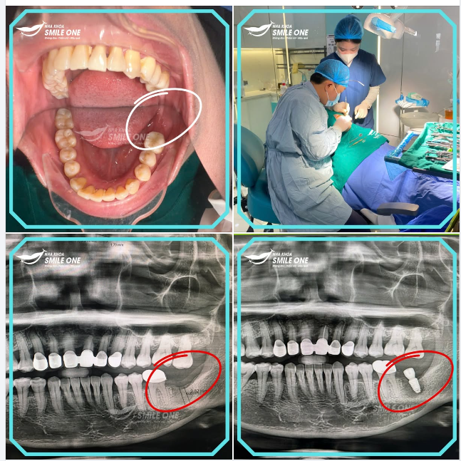 TRỒNG RĂNG IMPLANT PHỤC HÌNH RĂNG SỐ 7