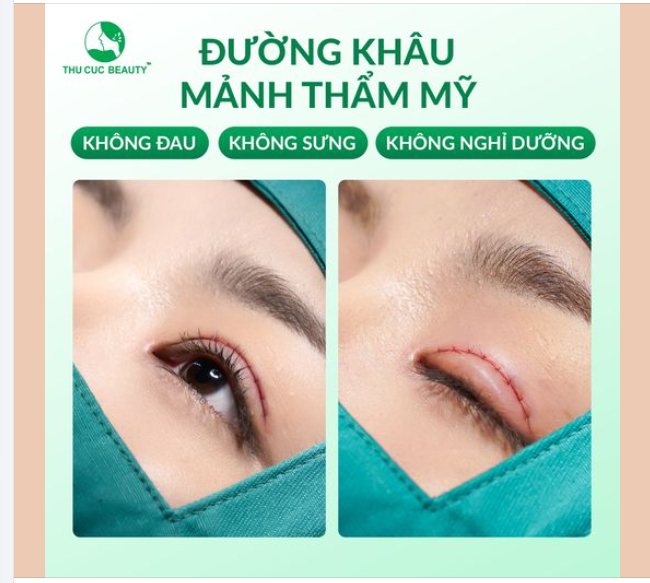 Đôi mắt to đẹp, đường khâu mảnh thẩm mỹ