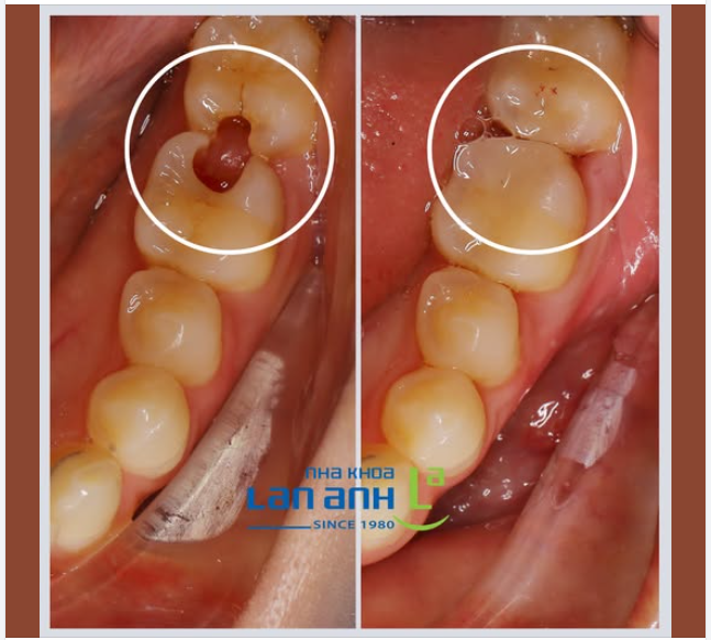 Trám răng cho khách Hàn Quốc, phải đạt được tiêu chuẩn đẹp và bền ạ!