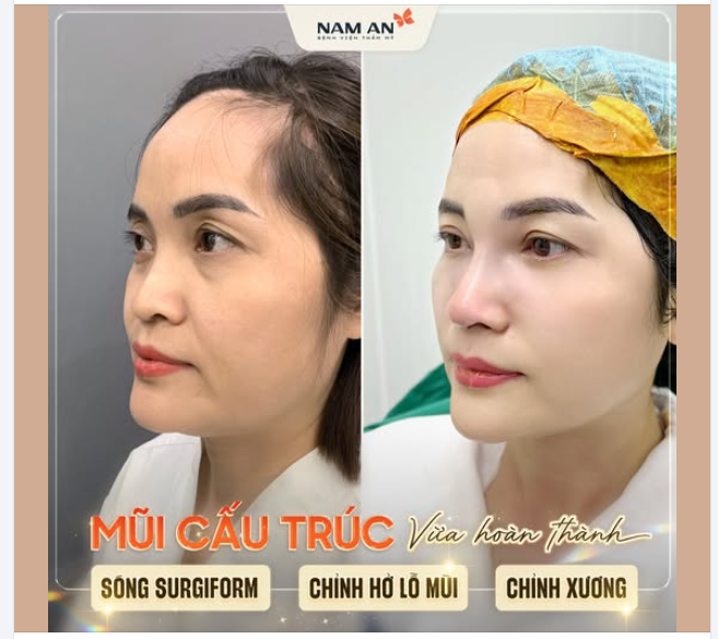 HOÀN THIỆN DÁNG MŨI CẤU TRÚC SỤN SURGIFORM