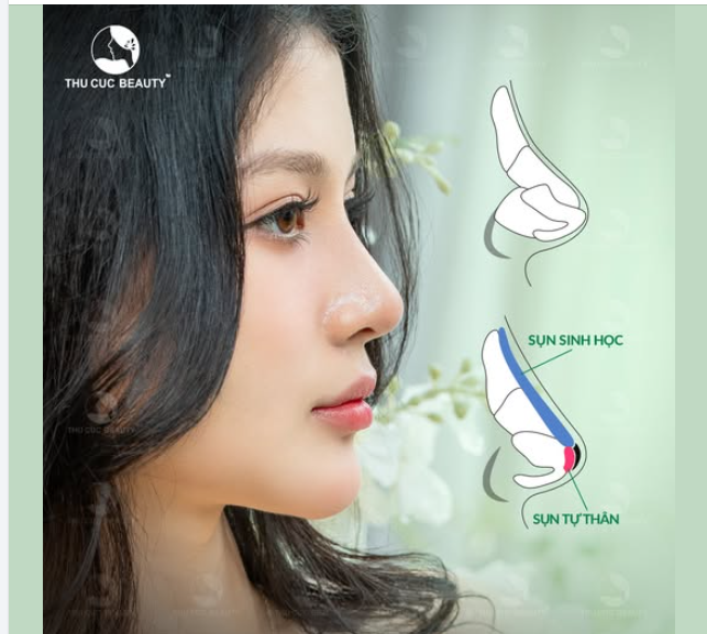 Chọn Mũi TC - Say "bye" mũi thấp sau 30P   Rinh dáng mũi cao thon, cân đối, hài hòa với gương mặt