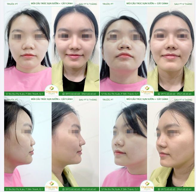 Nàng khách hàng này đã lựa chọn combo nâng mũi cấu trúc sụn sườn kết hợp với cắt cánh mũi tại TMV Charming