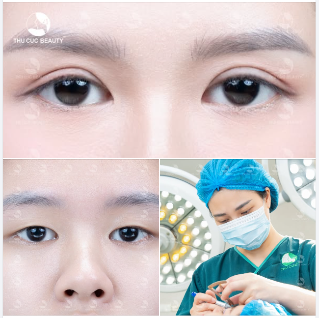 Giải cứu đôi mắt một mí, sụp mí