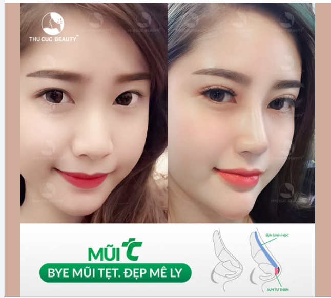Lý do  nhiều KH lựa chọn đến với Thu Cúc nâng mũi vì: