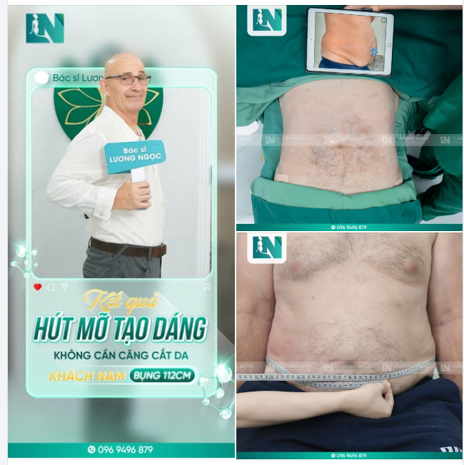 NAM GIỚI HOÀN TOÀN CÓ THỂ HÚT MỠ