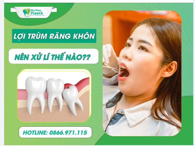 Top 05 cách xử lí khi bị lợi trùm răng khôn