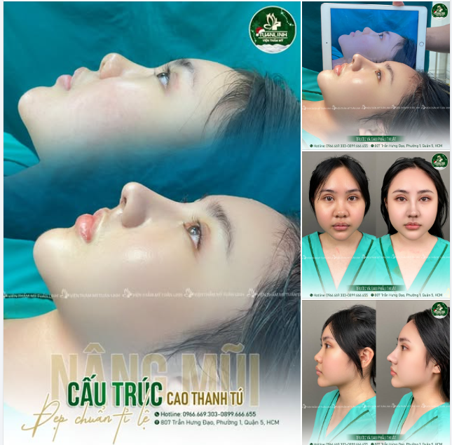 Nâng mũi cấu trúc - Nâng tầm diện mạo của bạn lên một tầm cao mới!!
