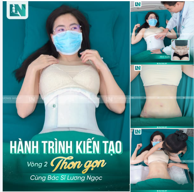 Mãn nhãn với kết quả sau 1 ngày hút mỡ siết eo tại Ekip Bác sĩ Luong Ngọc.