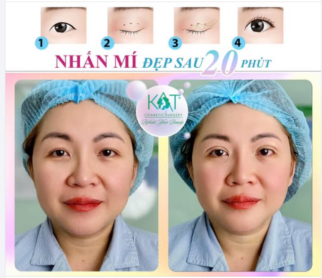 Best seller của KAT với 3 KHÔNG  KHÔNG ĐAU  KHÔNG SƯNG  KHÔNG NGHỈ DƯỠNG