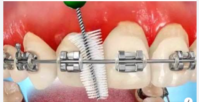 Tại sao nên dùng bàn chải kẽ răng cho răng niềng?
