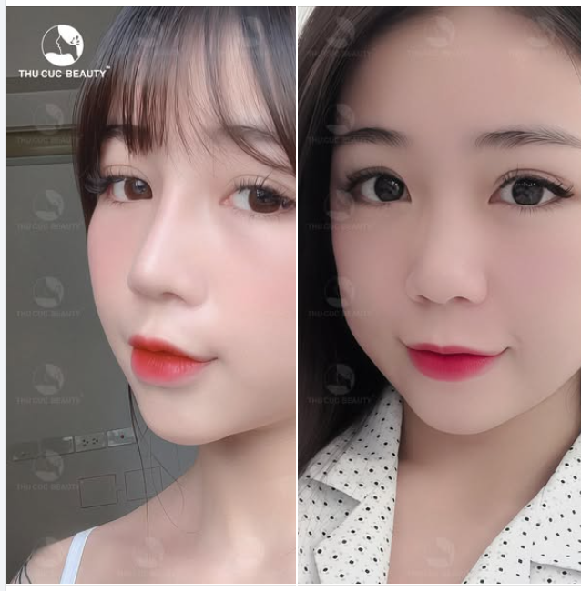 Nhan sắc nhân lên gấp đôi khi nâng mũi