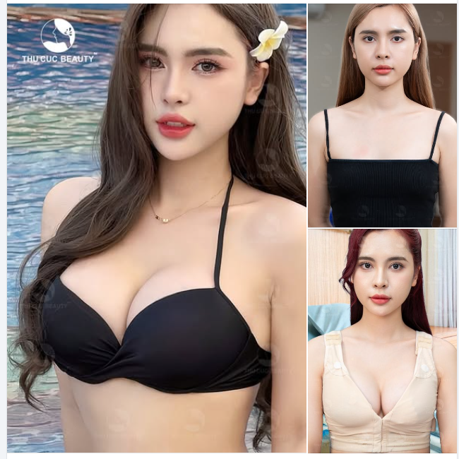 Nâng ngực xong bạn sẽ thấy tự tin thoải mái vận động