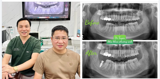 Ai Là Người Phù Hợp Để Làm Implant Răng?