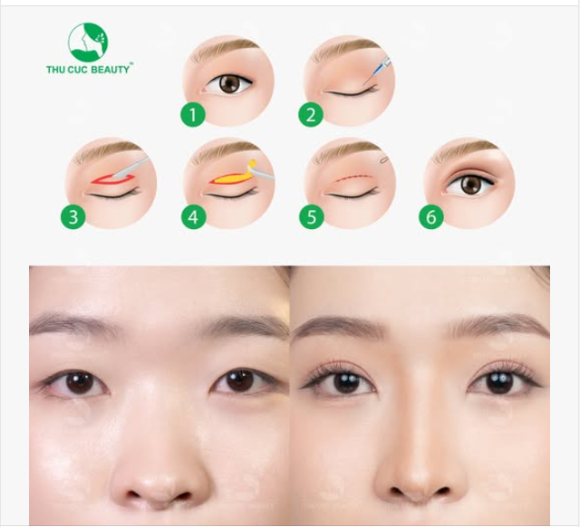 Cắt mí xong khiến khuôn mặt bạn ấy trông trẻ đẹp hơn rất nhiều