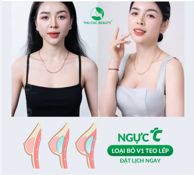 Sau nâng ngực Không còn tự ti vì V1 teo lép, khó diện đồ