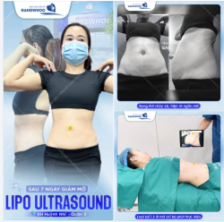 XÓA SẠCH BỤNG MỠ CHẢY XỆ, NGẤN MỠ NHỜ CÔNG NGHỆ LIPO ULTRASOUND