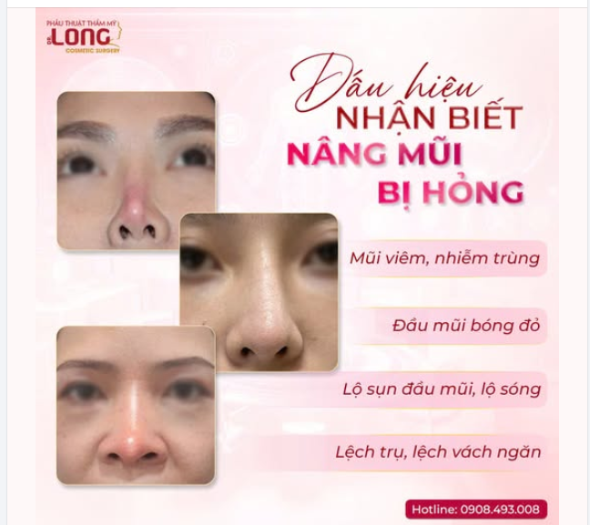 DẤU HIỆU “NHẬN BIẾT” NÂNG MŨI BỊ HỎNG