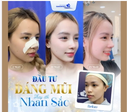 ĐẦU TƯ DÁNG MŨI - THAY ĐỔI NHAN SẮC