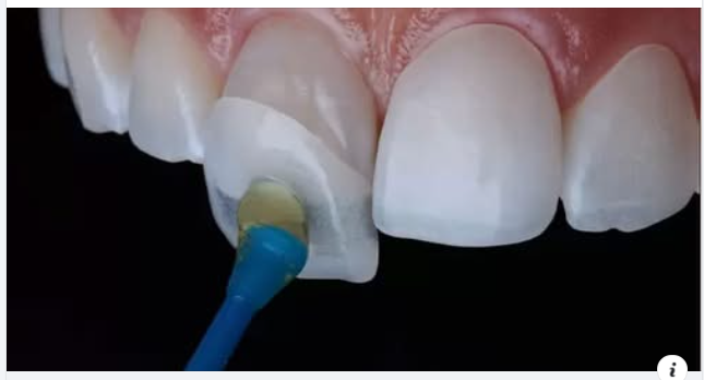 Tác hại của bọc răng sứ bị lệch khớp cắn và cách chữa trị hiệu quả