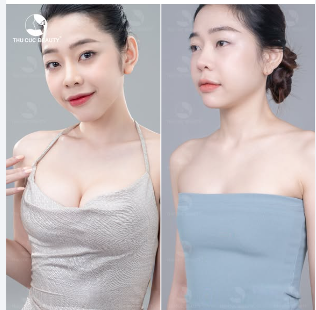 TC Túi ngực cao cấp chính hãng, mềm mại, tự nhiên.