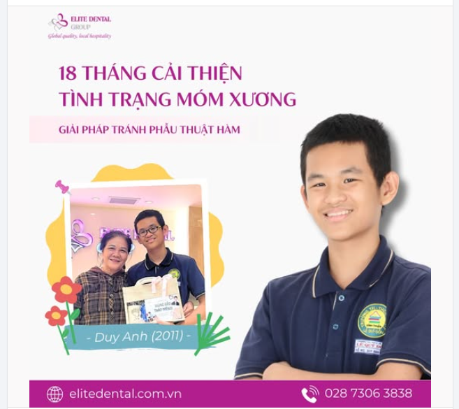 18 THÁNG CẢI THIỆN TÌNH TRẠNG MÓM XƯƠNG: HÀNH TRÌNH CỦA DUY ANH VÀ GIẢI PHÁP TRÁNH P.H.Ẫ.U T.H.U.Ậ.T HÀM