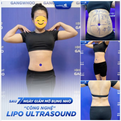 KẾT QUẢ SAU 7 NGÀY GIẢM MỠ BỤNG CÔNG NGHỆ LIPO ULTRASOUND