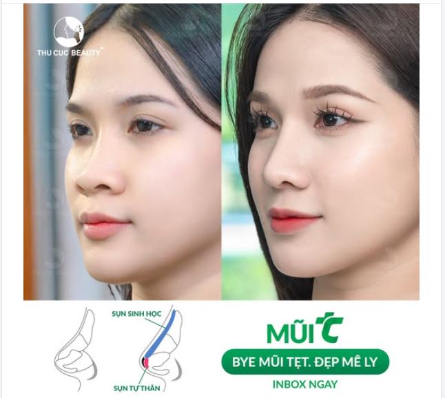 Mũi thấp tẹt, to bè hóa thon gọn cao sang Chọn Mũi TC 11.9Tr