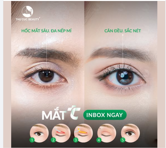 Hốc mắt sâu đa nếp mí khiến đôi mắt bạn trông buồn thiếu sức sống