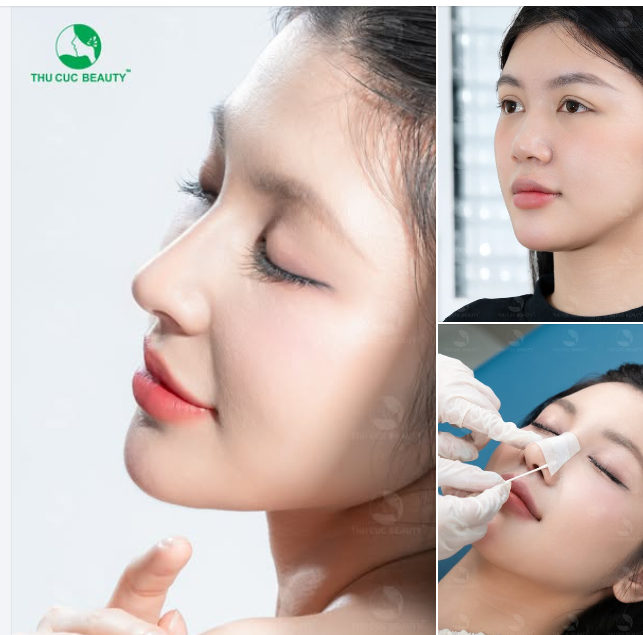 Góc nghiêng thần thánh sau nâng mũi
