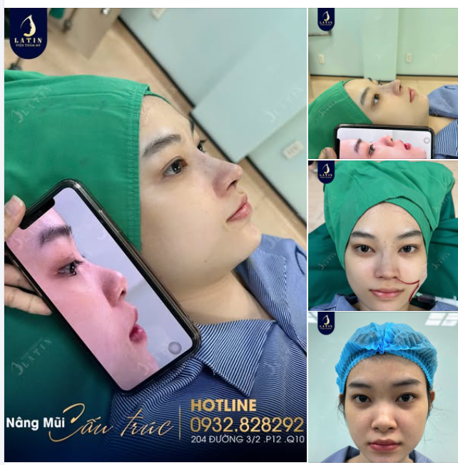 Mũi đẹp đếm ngược đón Tết...  Mũi cấu trúc sụn tai vừa hoàn thành tại Latin cho em gái T.N