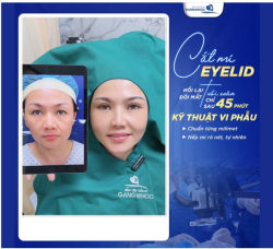 CẮT MÍ EYELID - HỒI LẠI ĐÔI MẮT TUỔI XUÂN CHỈ SAU 45 PHÚT