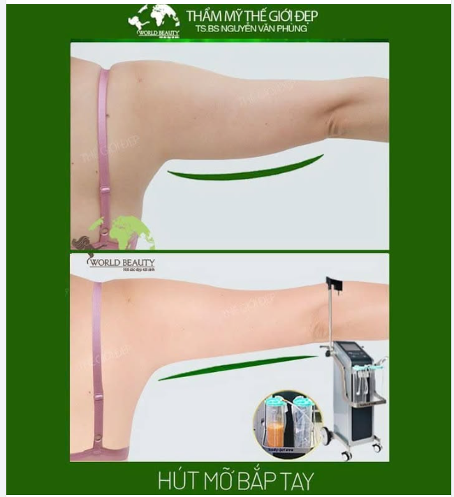 Hình ảnh Khách hàng cải thiện loại bỏ mỡ thừa vùng bắp tay sau 1 tháng bằng công nghệ Hút mỡ Body Jet Evo được thực hiện bởi đội ngũ Bác sĩ Thế Giới Đẹp!
