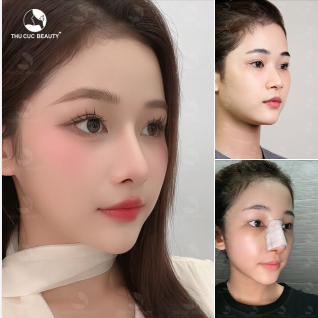 Nâng mũi TC sau 30P thực hiện loại bỏ tình trạng mũi thấp, đầu mũi to