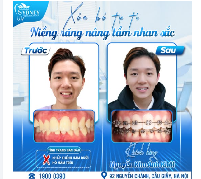 XÓA BỎ TỰ TI - NIỀNG RĂNG NÂNG TẦM NHAN SẮC