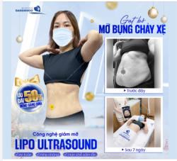 GẠT BỎ MỠ BỤNG CHẢY XỆ SAU 10 NĂM