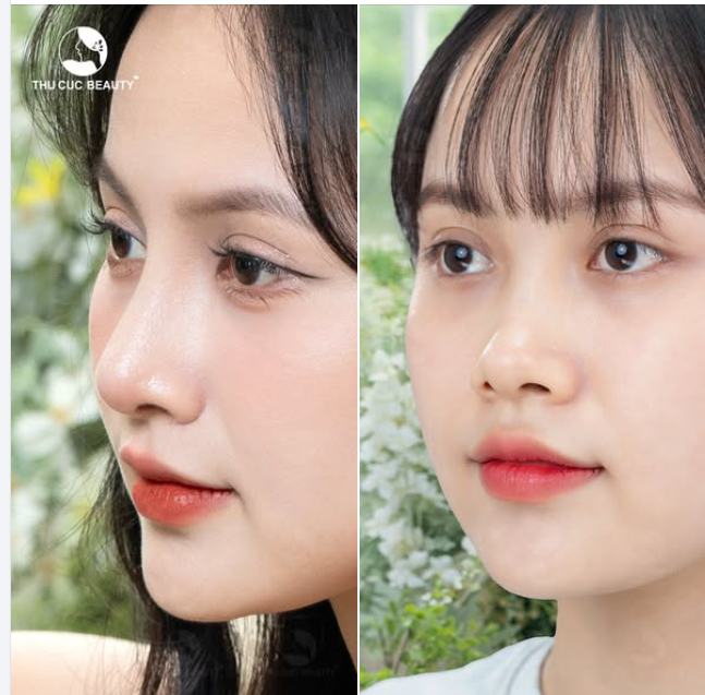 Đến TC bạn không còn lo lắng về chiếc mũi
