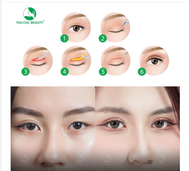 Đôi mắt biết nói khuôn mặt tươi sáng nhờ cắt mí TC