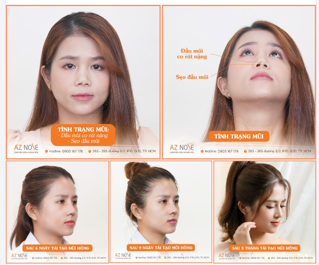 Từng đối mặt với nhiều khó khăn sau 4 lần can thiệp thẩm mỹ không thành công, nhưng chỉ sau 3 tháng, cuộc sống của chị N.L. (Bình Phước) đã hoàn toàn đổi khác: