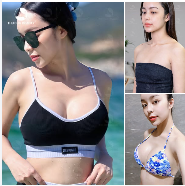 Kỹ thuật đặt túi nâng ngực tại TC