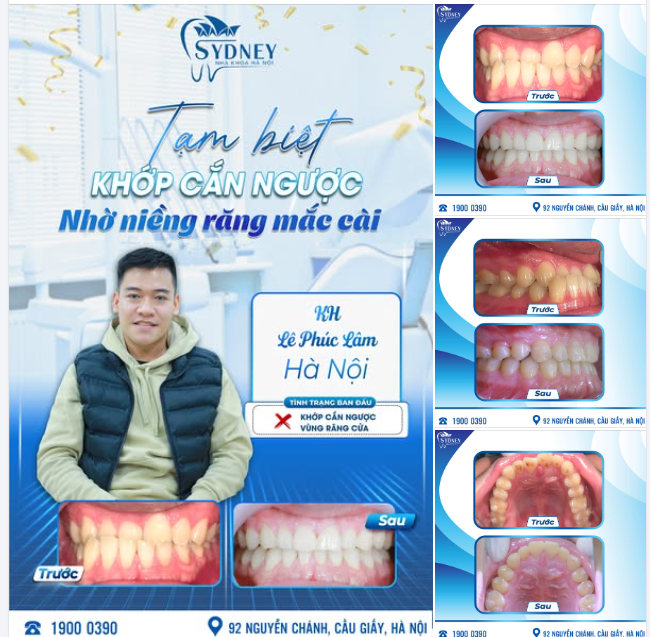 TẠM BIỆT KHỚP CẮN NGƯỢC NHỜ NIỀNG RĂNG MẮC CÀI