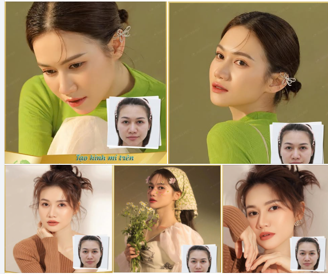 Sở hữu kết quả nếp mí mới to rõ, hài hòa.