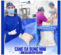 CĂNG DA BỤNG MINI TẠI BVTM GANGWHOO