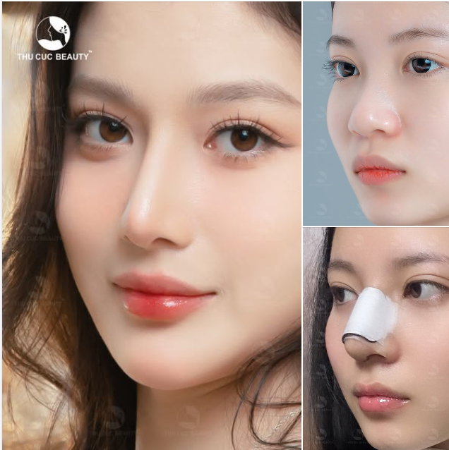 Sở hữu dáng mũi tự nhiên trong mơ sau 30P