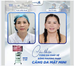 Phương pháp căng da mặt mini  chủ yếu dùng cho các trường hợp chưa xuất hiện nhiều tình trạng lão háo da, chủ yếu ở một số vùng nhất định.