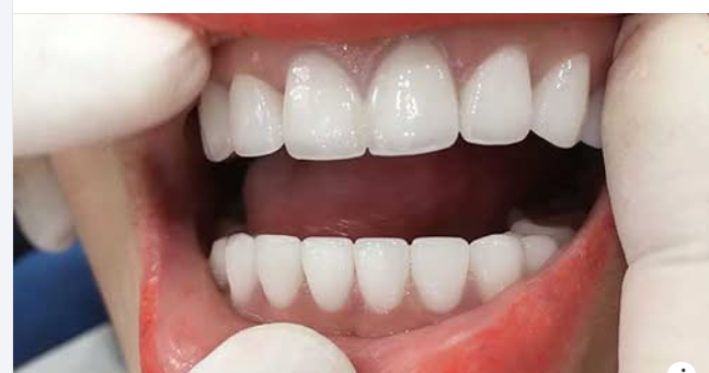 So Sánh Hàm Giả Tháo Lắp Và Trồng Răng Implant