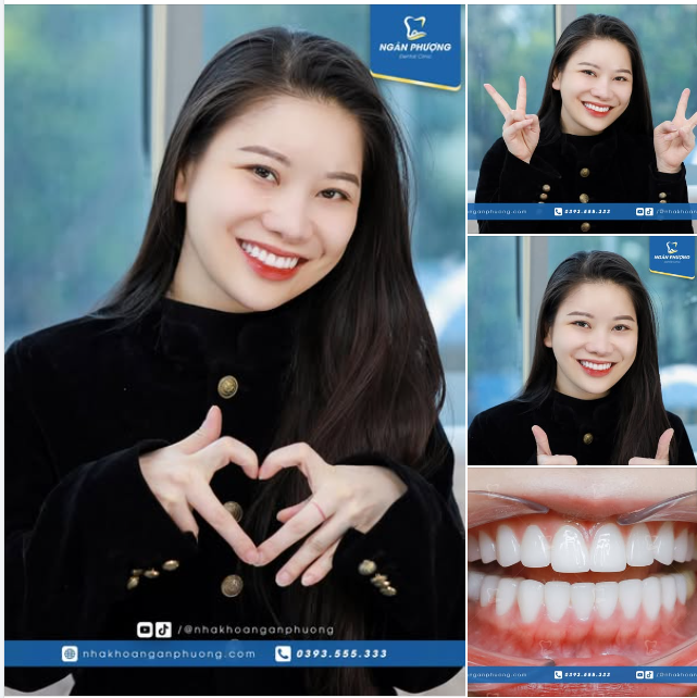 Răng sứ Orodent sau 1 năm tái khám sẽ như thế nào?